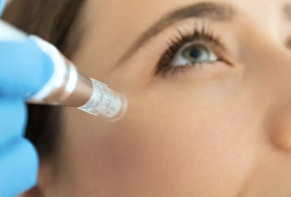 The Differences Between The Most Popular Radio-Frequency Microneedling Treatments