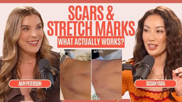 What Really Works for Scars & Stretch Marks? Esthetician Amy Peterson Breaks It Down